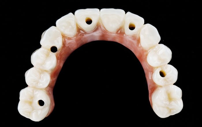 即時荷重インプラント