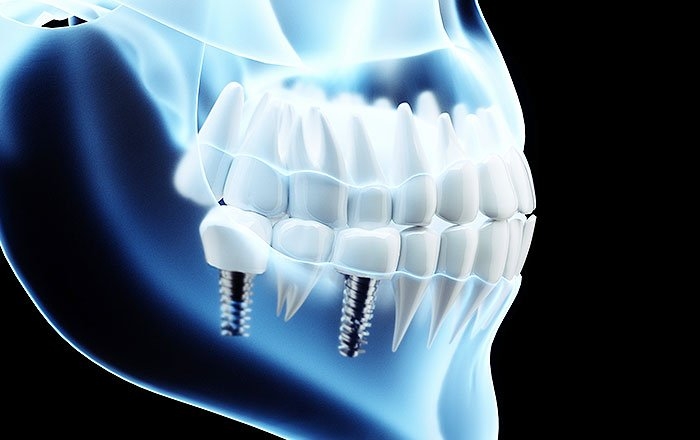 噛み合わせている歯の側にも生じる問題：咬合性外傷（こうごうせいがいしょう）