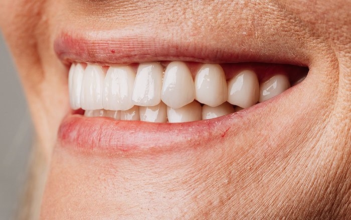 ④経過観察を行い、最終的な人工歯（被せ物）の装着へ