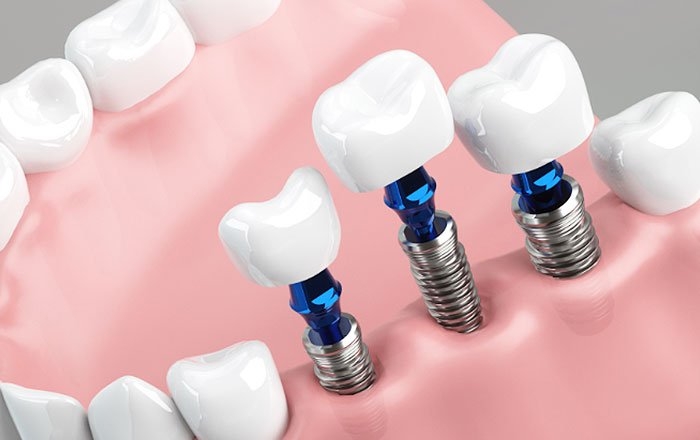 即時荷重インプラントと通常のインプラント治療との違い