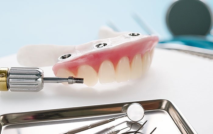 なるべく早く歯を元通りにしたいとお考えの方もインプラントオフィス大通にご連絡を