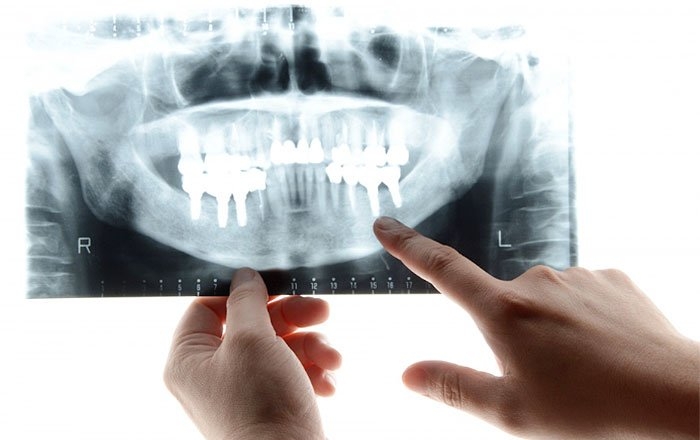 インプラントの噛み合わせのバランスが崩れると起こりうる問題：周囲の骨のダメージ