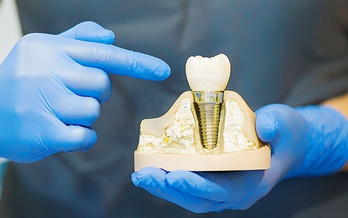 インプラントの噛み合わせのバランスが崩れると起こりうる問題：上部構造の破損