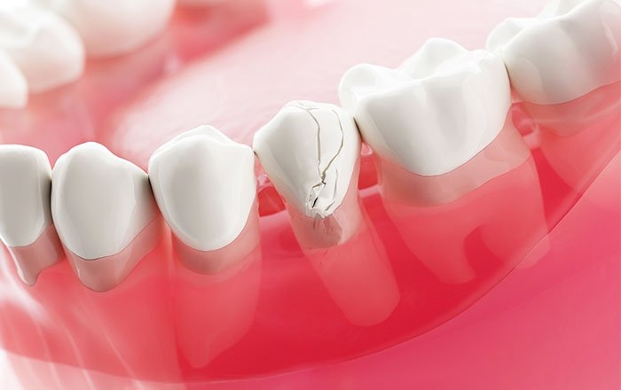 噛み合わせている歯の側にも生じる問題：歯の破折（はせつ）