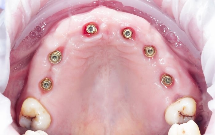 ③手術と仮歯の装着