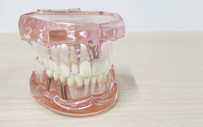 インプラントの噛み合わせはなぜ重要？天然歯との違いと咬合調整が必要な理由