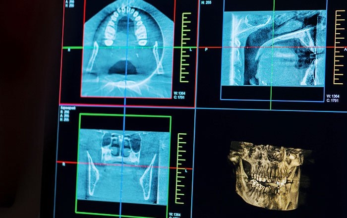 プレシジョンインプラントの特徴：詳細な検査