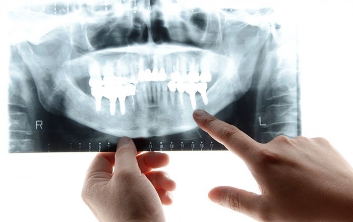 プレシジョンインプラントのメリット：治療後のリスクを抑えられる