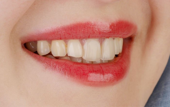 プレシジョンインプラントのメリット：自然で違和感のない仕上がり