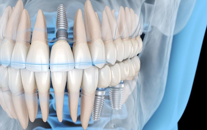 プレシジョンインプラント～患者さん一人ひとりに最適化された精密インプラント治療
