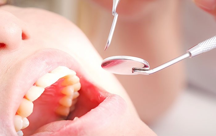 インプラント治療中に美容施術を避けるべき3つの理由：口を大きく開けにくくなる施術がある