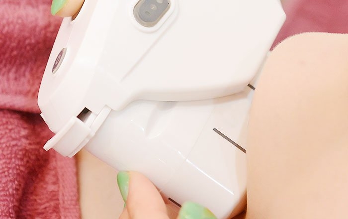 インプラント治療後にできる美容施術と注意点：ハイフ（HIFU：高密度焦点式超音波）