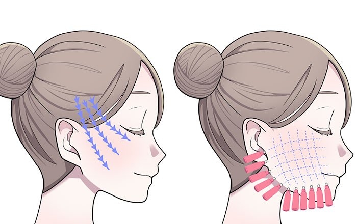 インプラント治療後にできる美容施術と注意点：糸リフト（スレッドリフト）