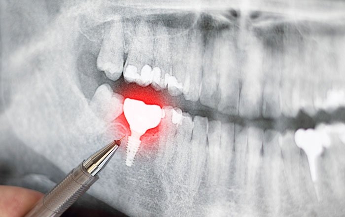 インプラント治療中に美容施術を避けるべき3つの理由：傷口への刺激が回復を遅らせる