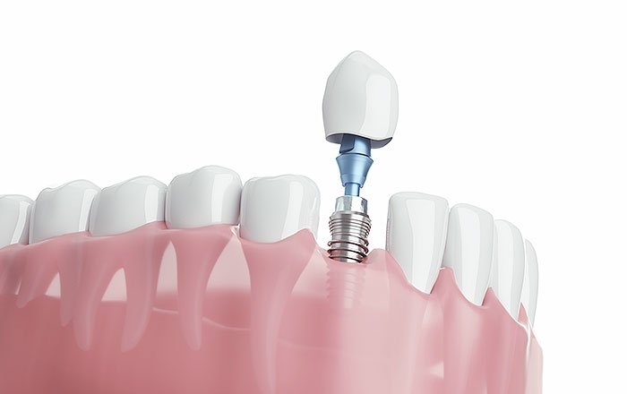 ケース1：年収400万円・インプラント1本を入れて50万円かかった場合