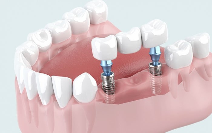 ケース2：年収700万円・インプラント2本を入れて90万円かかった場合
