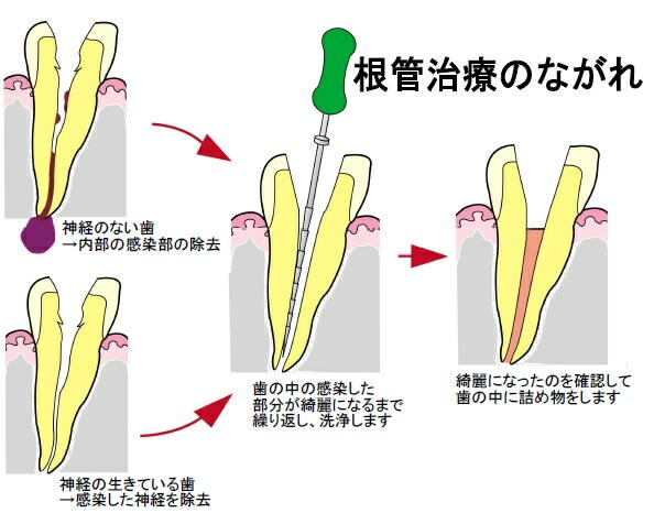 根の治療の対処法 スタッフブログ ブログ 札幌 インプラントオフィス大通