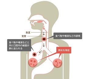 誤嚥性肺炎 スタッフブログ ブログ 札幌 インプラントオフィス大通 誤嚥性肺炎 スタッフブログ ブログ 札幌 インプラントオフィス大通